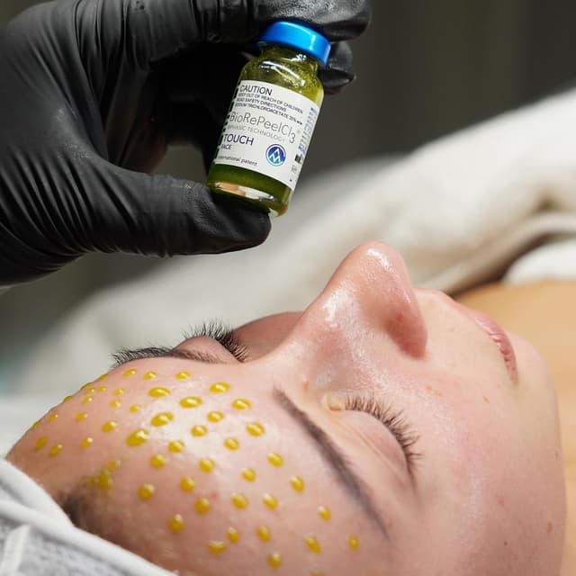 4 BioRePeel Advanced Sessions at Skin Wellness by Tina in Naperville, IL